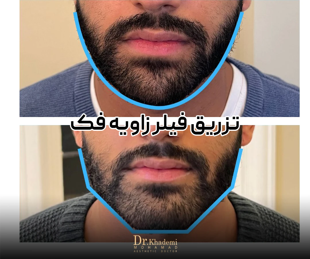 تزریق فیلر زاویه فک