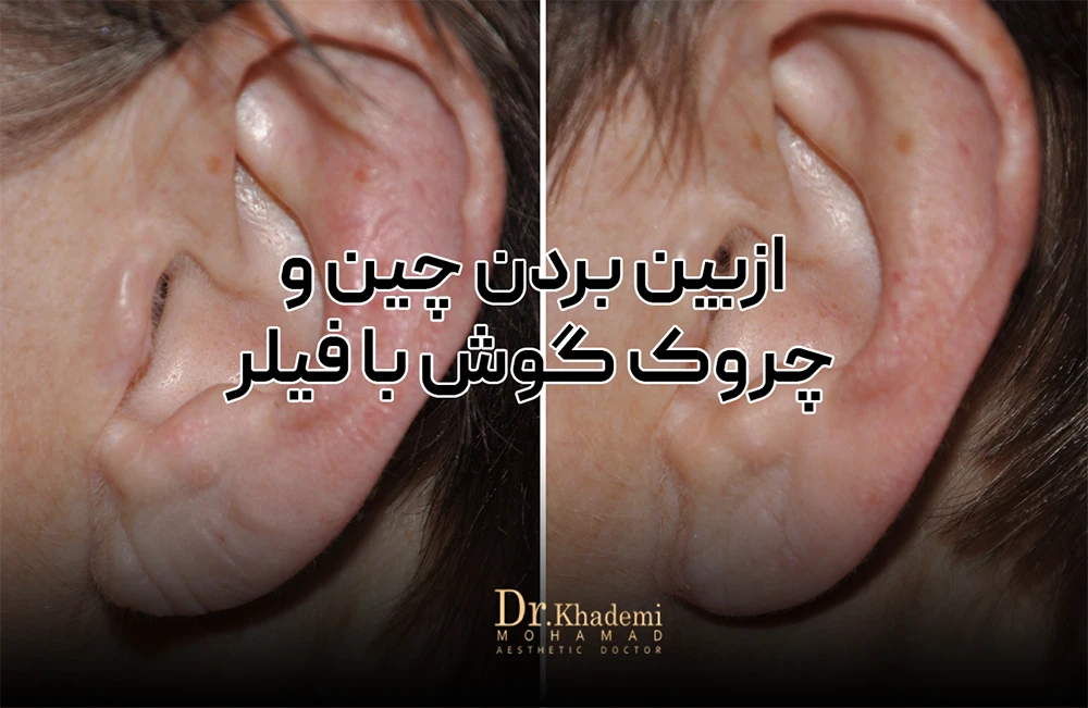 عکس قبل و بعد با تزریق گوش فیلر