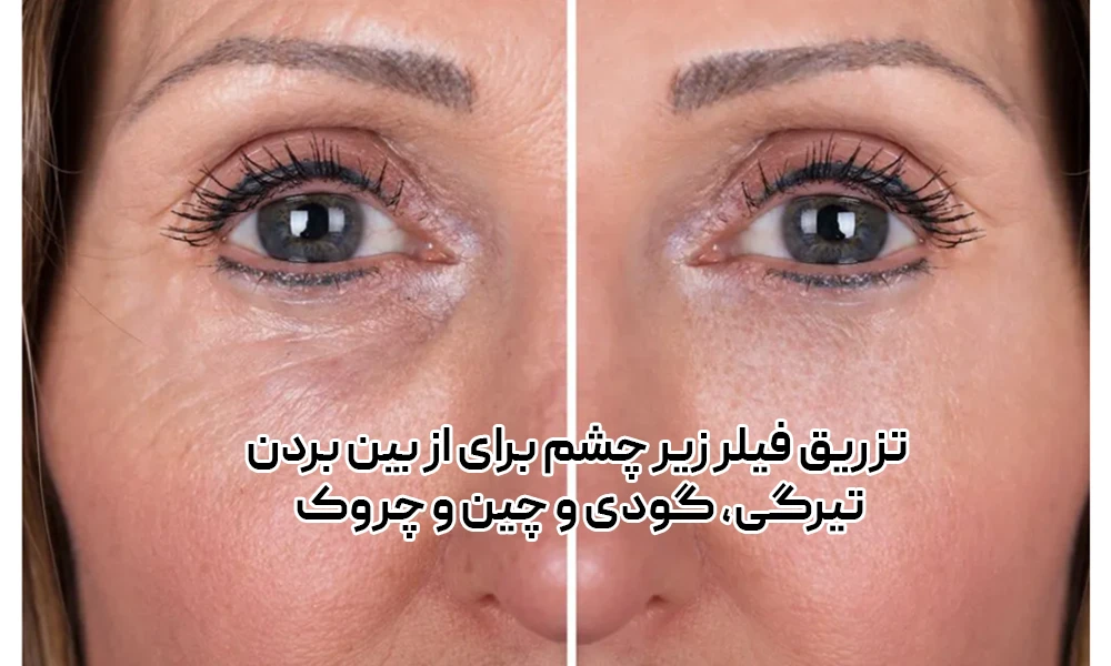 عکس قبل و بعد تزریق فبلر زیر چشم