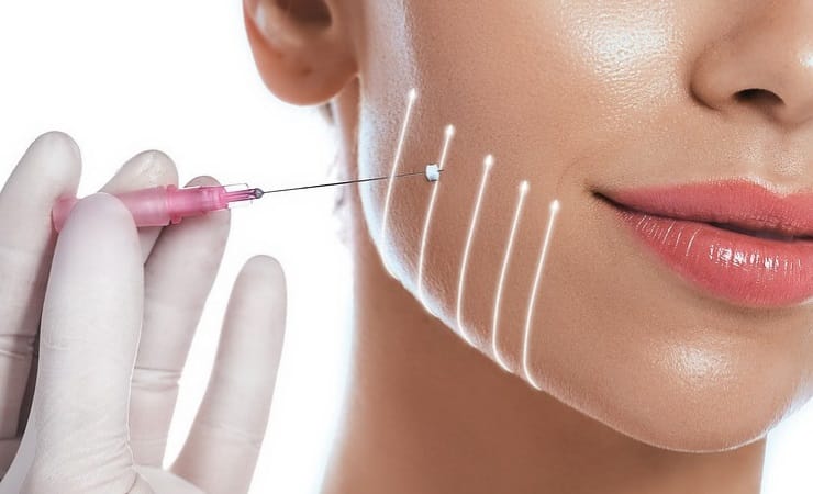 تصویر نحوه تزریق فیلر برای زاویه‌سازی فک-دکتر خادمی