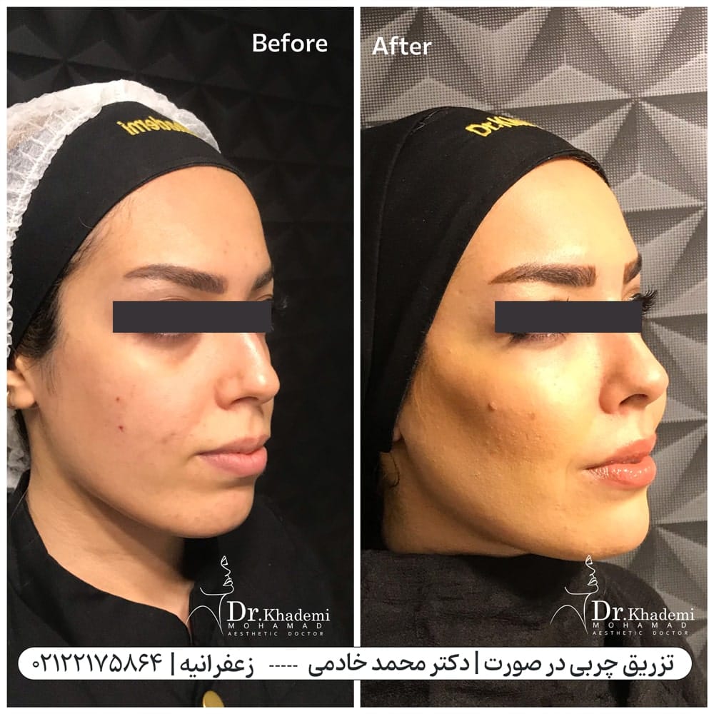 کانتورینگ صورت با تزریق چربی