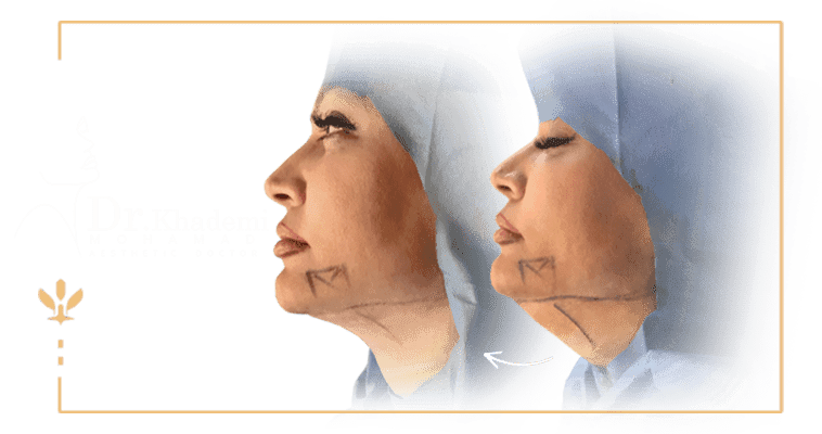 عکس قبل و بعد غبغب