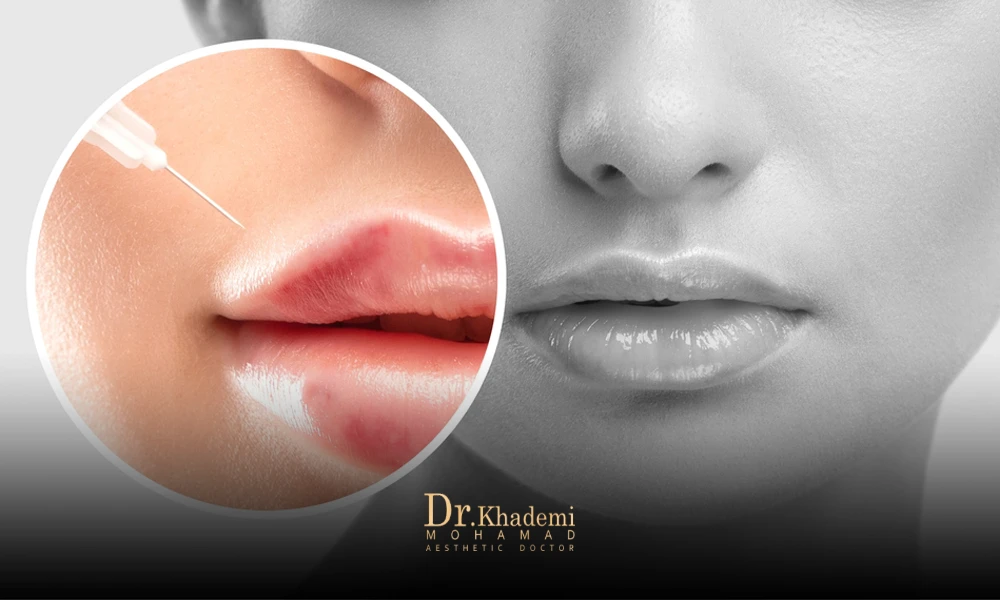 تصویر از لب یک خانم که که بعد از تزریق فیلر بی ورم کرده - ورم لب بعد از تزریق فیلر