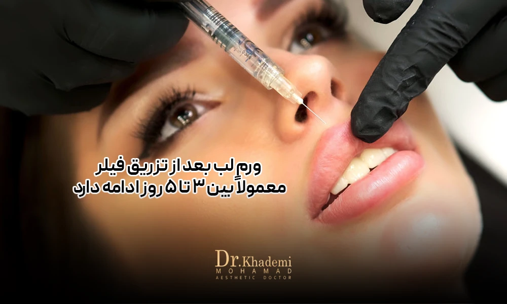 عکس صورت یک خانم است که دکتر در حال تزریق فیلر لب هست و لبش بعد از تزریق ورم کرده است