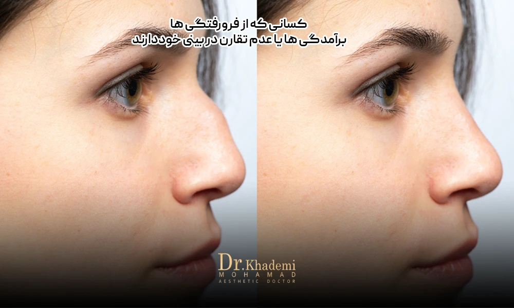 قبل و بعد بینی یک خانم است بعد از تزریق فیلر برای رفع قوز بینی